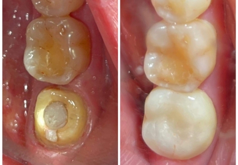Bọc răng sứ có đau không? Có ảnh hưởng gì không? 